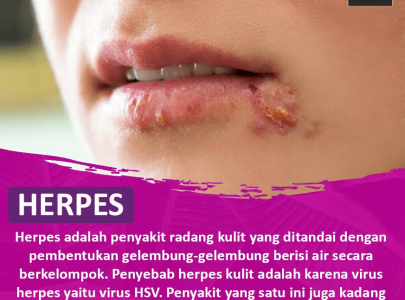 PENGOBATAN HERPES DENGAN VARASH NATURAL OIL