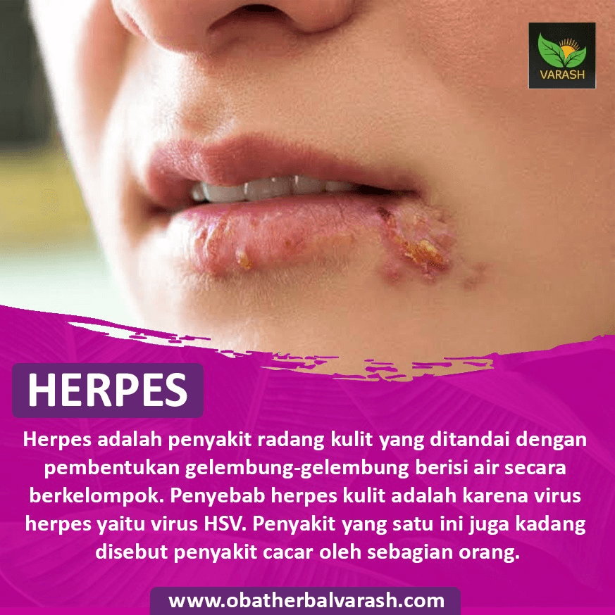 herpes sembuh dengan varash