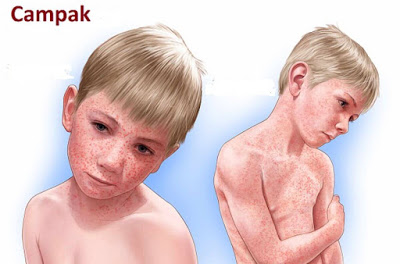 PENGOBATAN SAKIT CAMPAK DENGAN VARASH NATURAL OIL