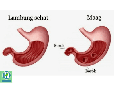 SAKIT MAAG SEMBUH SETELAH DI BALURKAN VARASH NATURAL OIL