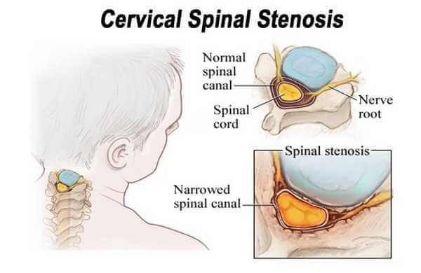pengobatan cervical stenosis dengan varash