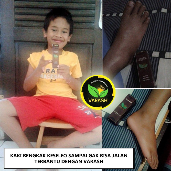 bengkak keseleo sembuh dengan minyak varash classic oil