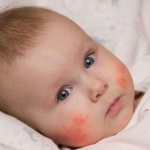 Hasil gambar untuk Dermatitis Atopik