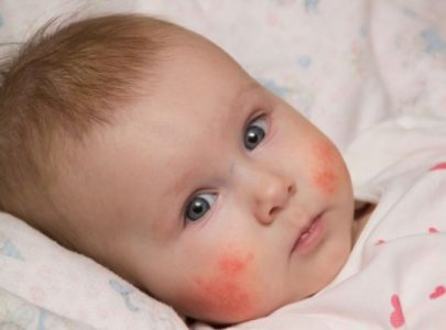 DERMATITIS ATOPIK TERBANTU DENGAN VARASH