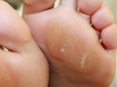 Kapalan Hilang Karena Varash Natural Oil