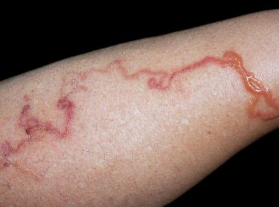 Cutaneous Larva Migrans Sembuh Dengan Varash