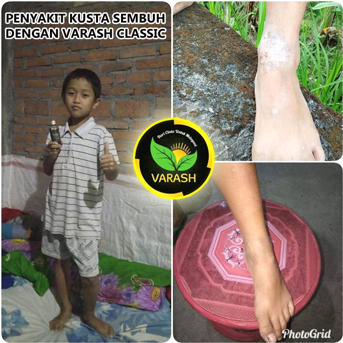 terapi sakit kusta minyak varash classic oil