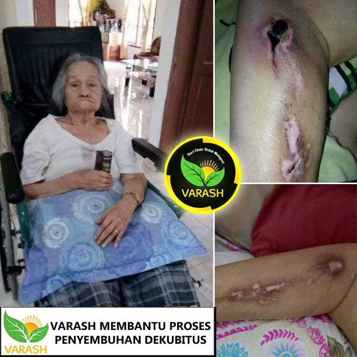dekubitus sembuh dengan minyak varash