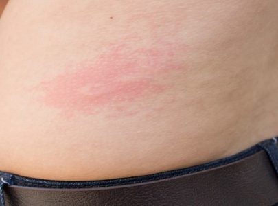 DEKUBITUS SEMBUH DENGAN VARASH NATURAL OIL