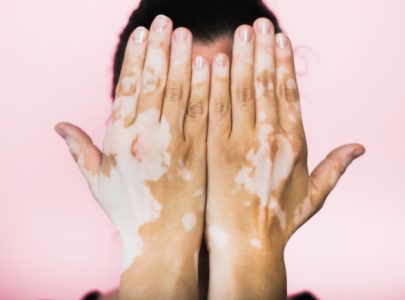 VITILIGO HILANG DENGAN VARASH