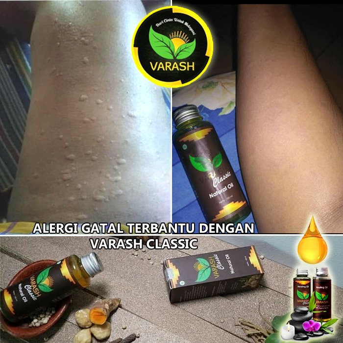 gatal alergi diterapi minyak varash classic oil