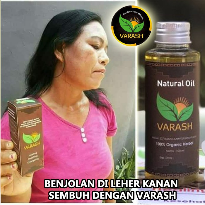 benjolan di leher terbantu dengan minyak varash classic oil