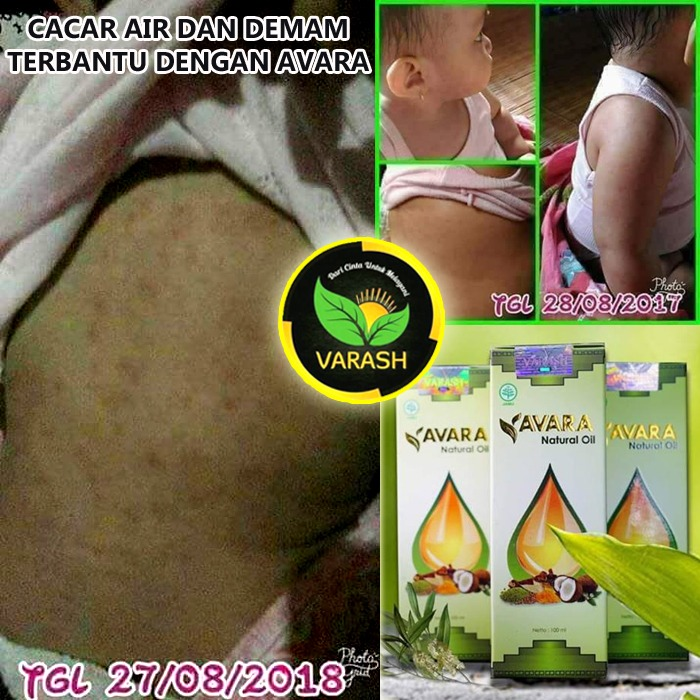 terapi cacar air dengan varash classic