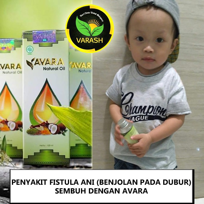 terapi fistula benjolan pada dubur dengan avara varash