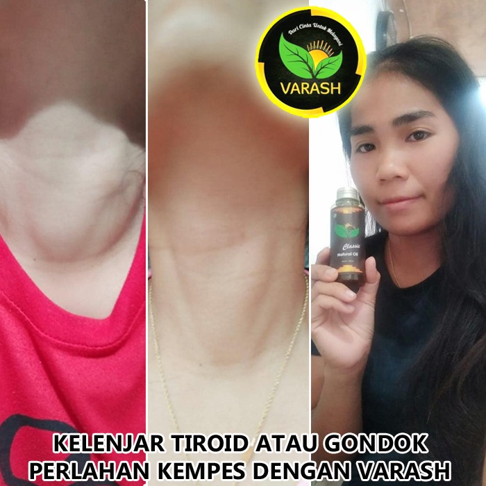 terapi gondok terbantu minyak varash classic oil