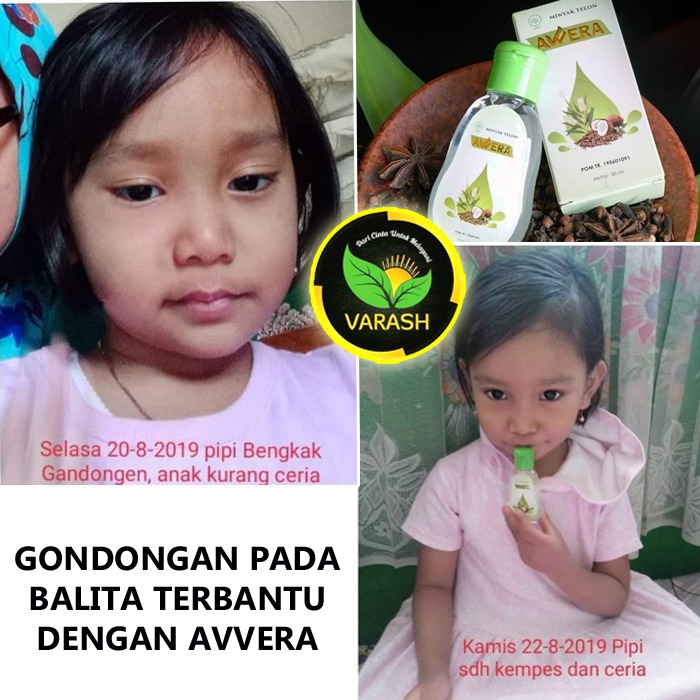 gondongan terbantu dengan minyak avvera