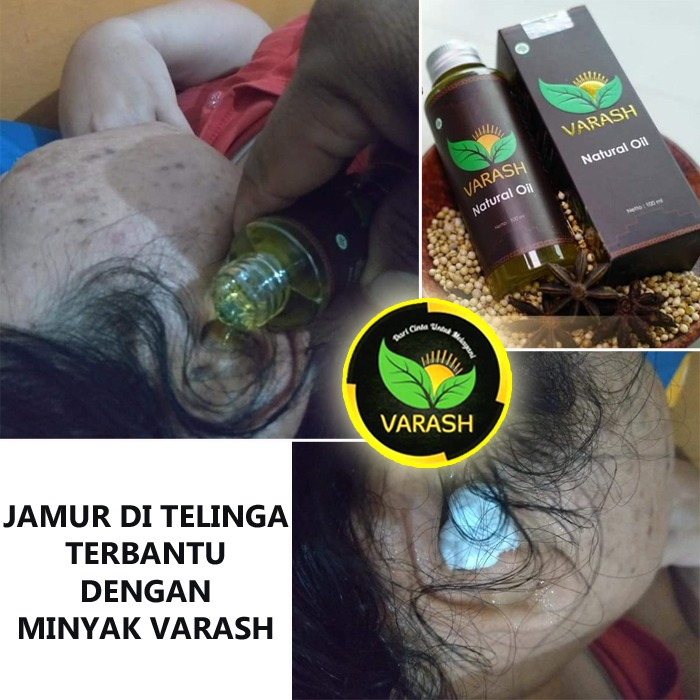 Jamur ditelinga terbantu dengan minyak varash