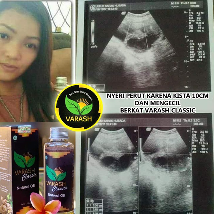 kista diterapi dengan minyak varash classic oil