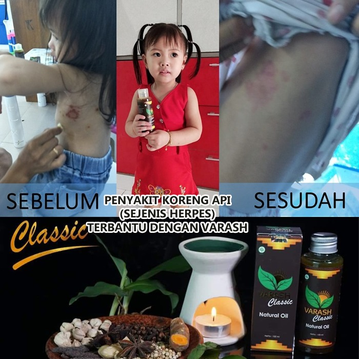 koreng sembuh diterapi minyak varash classic oil