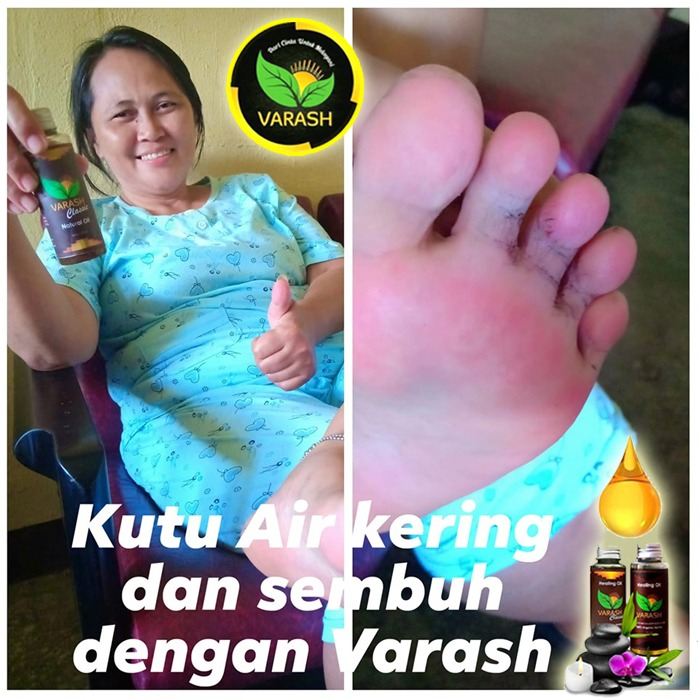 kutu air teratasi dengan varash natural oil