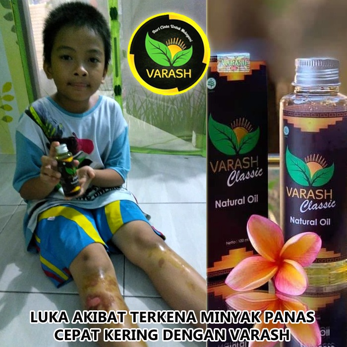 luka air panas diterapi minyak varash classic oil