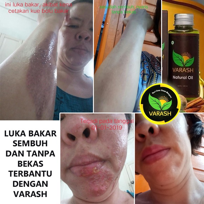 luka bakar teratasi dengan varash