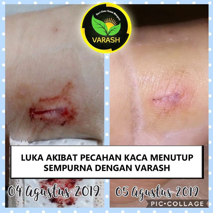 luka cepat kering dengan varash