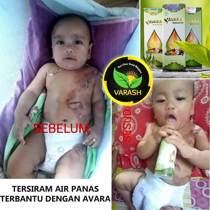 bayi tersiram air panas pulih dengan avara