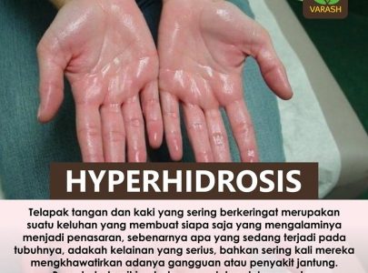 Cara Menangani Hyperhidrosis (Mengalami Keringat Berlebih)