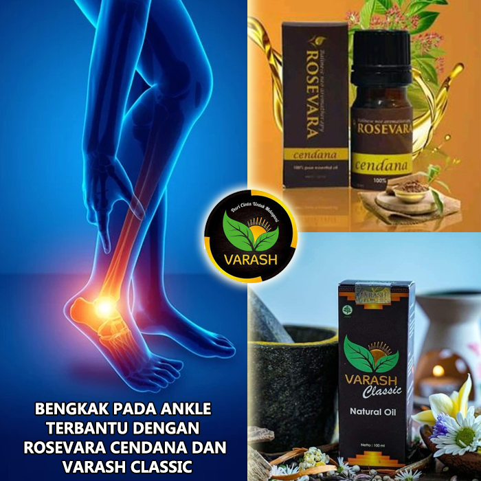 bengkak pada angkle tumit terbantu minyak varash classic oil