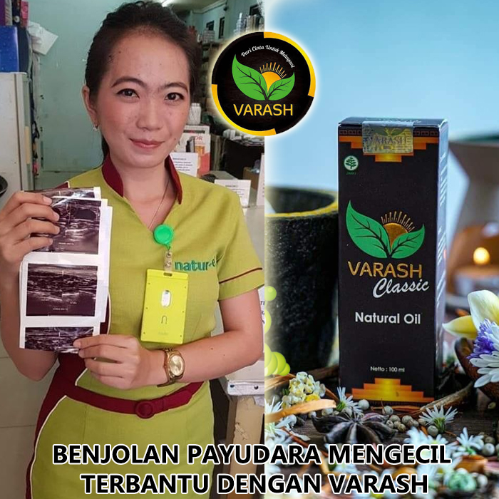 benjolan di payudara terbantu varash natural classic oil