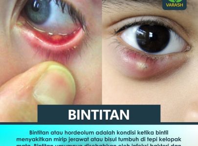 Apa itu Bintitan?