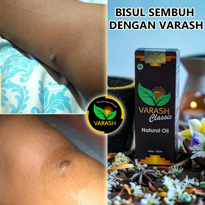 bisul terbantu varash natural classic oil