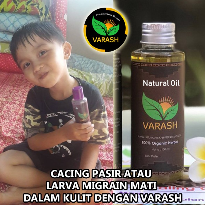 cacing pasir larva migrans diterapi varash natural classic oil