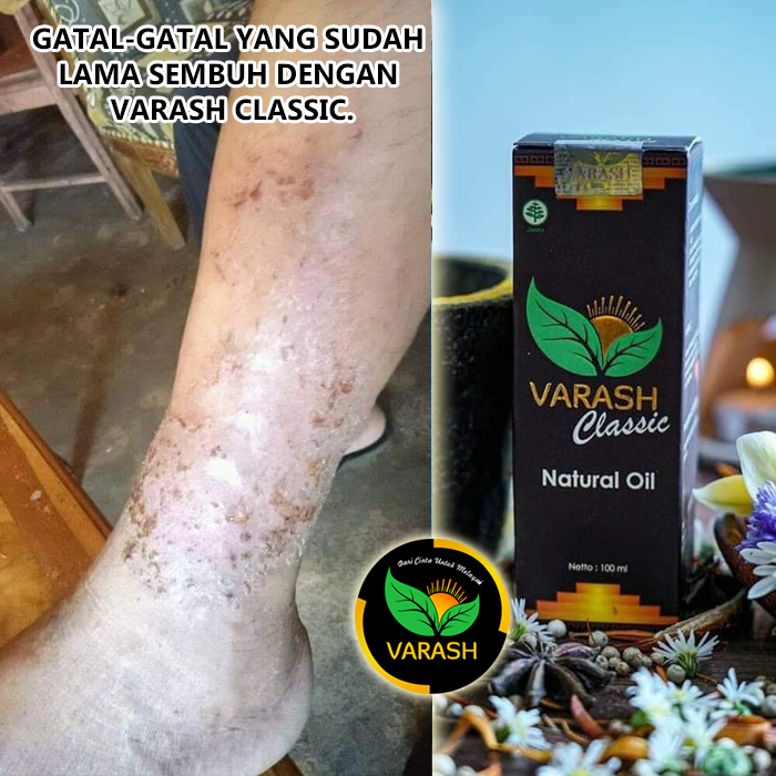 gatal kaki menahun terbantu varash natural classic oil
