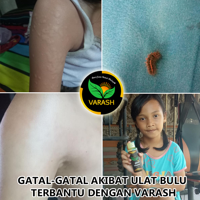 gatal ulat bulu terbantu varash natural classic oil