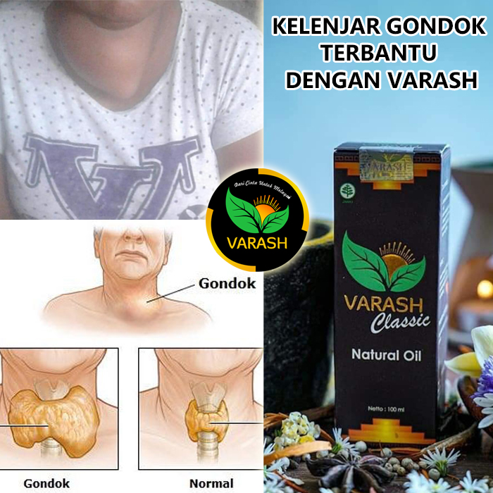 kelenjar gondok terbantu varash natural classic oil