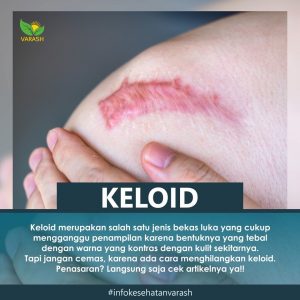 keloid terbantu dengan varash