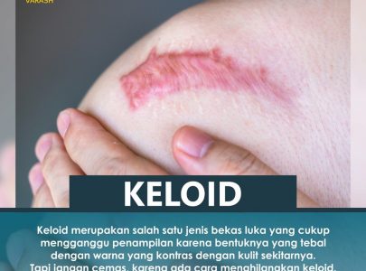 APA ITU KELOID?