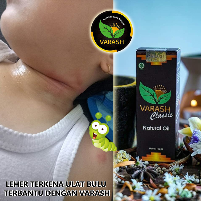terkena ulat bulu terbantu varash natural classic oil