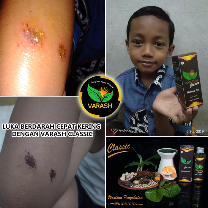 luka cepat kering dengan varash natural classic oil