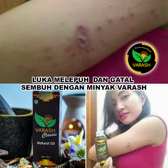 luka melepuh terbantu varash natural classic oil