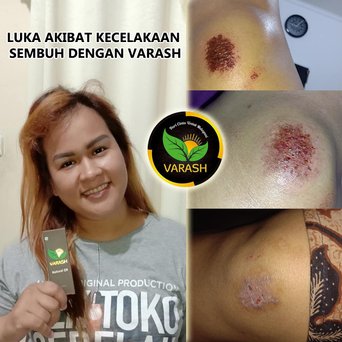 luka terbuka terbantu minyak varash classic oil