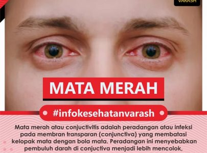 Apa itu Konjungtivitis