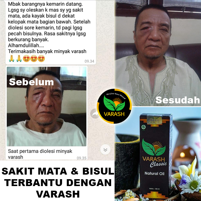 sakit mata dan bisul terbantu varash natural classic oil