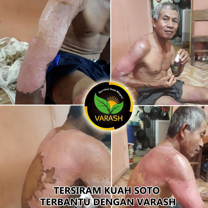 tersiram air panas sembuh dengan varash natural oil