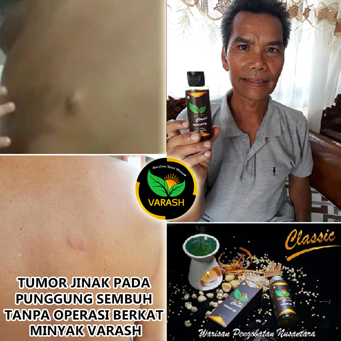tumor jinak varash natural classic oil