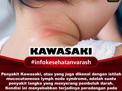 APA ITU PENYAKIT KAWASAKI?