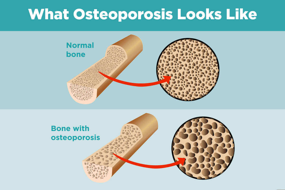 osteoporosis diatasi dengan varash