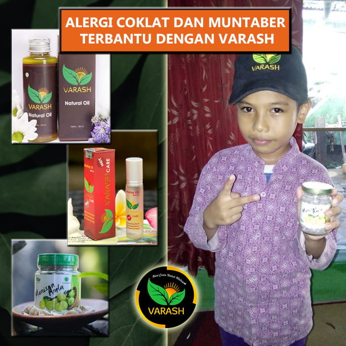 alergi makanan coklat, muntaber terbantu varash natural oil